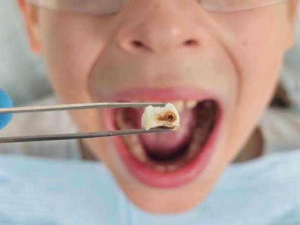 Best Emergency Tooth Extraction in Siloam Springs, AR
